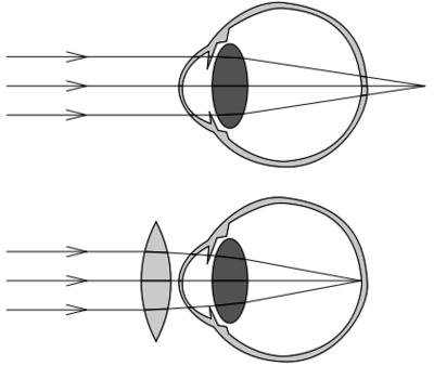 8. Defectos de la visión. Hipermetropía y miopía. - Portfolio Academico