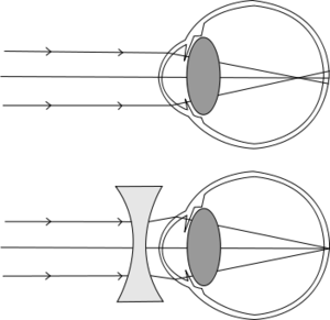 Myopia-2-3.svg.png